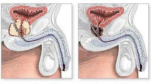 Antes e depois do tratamento da prostatite crônica cirurgicamente