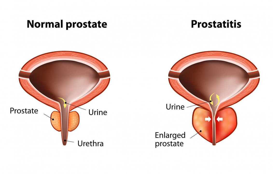Próstata normal de um homem saudável e inflamação da próstata com prostatite