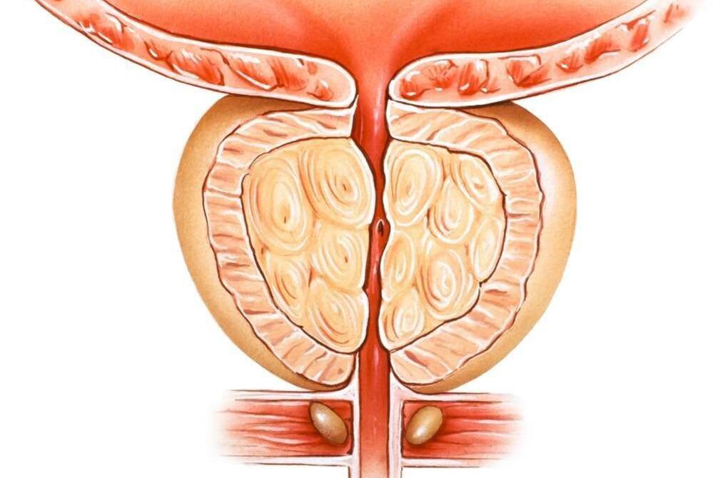 prostatite congestiva