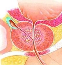 Adenoma da próstata